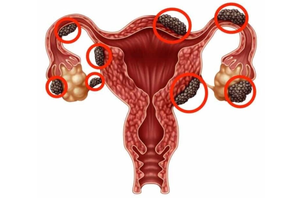 Ενδομητριωσική κύστη (ενδομητρίωμα)