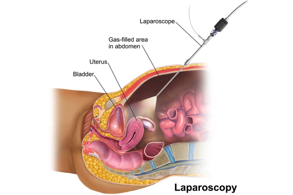 laparoskopiki-afairesi-endomitriosikis-kistis-1