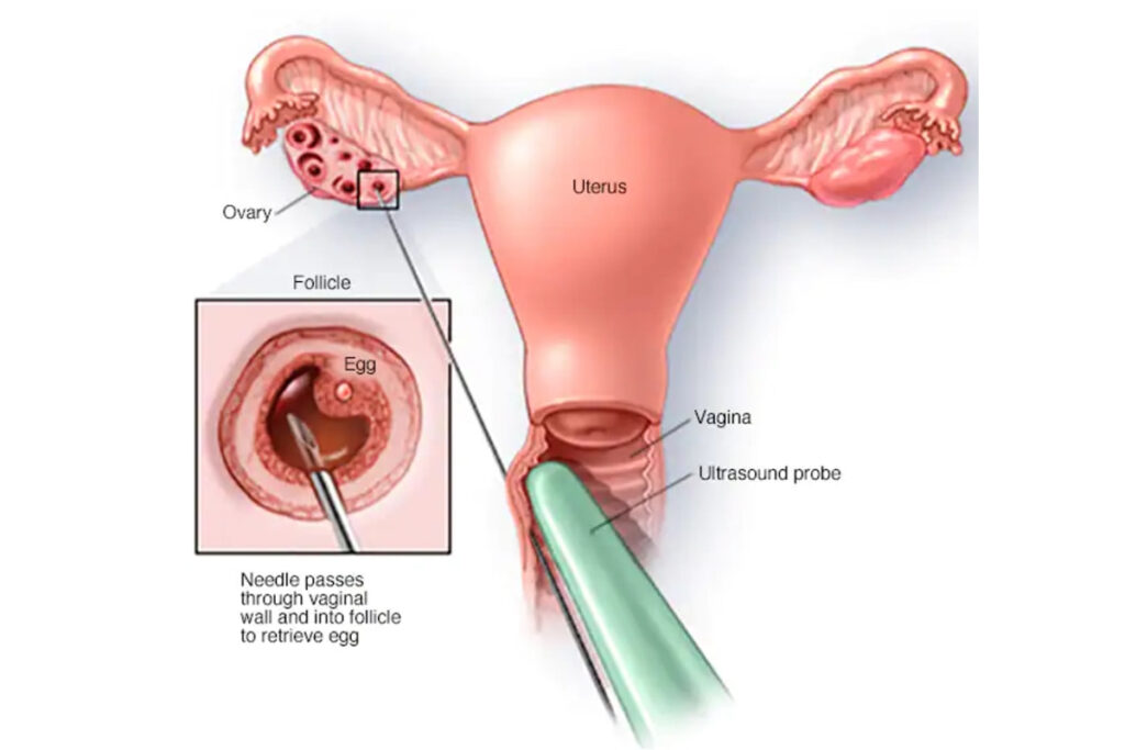 Οσα πρέπει να γνωρίζετε για την εξωσωματική γονιμοποίηση 1 Συλλογή ωαρίων - Ωοληψία